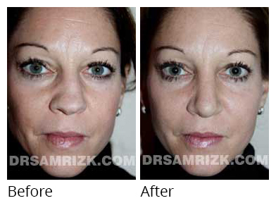 Female face, before and after Rhinoplasty treatment, front view, patient 29