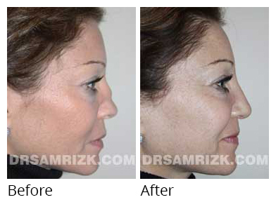 Female face, before and after Rhinoplasty treatment, side view, patient 29
