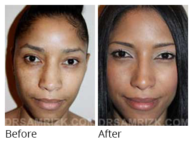 Female face, before and after Rhinoplasty treatment, front view, patient 30