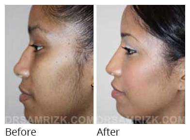 Female face, before and after Rhinoplasty treatment, side view, patient 30