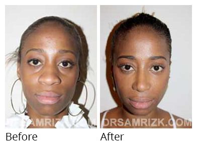 Female face, before and after Rhinoplasty treatment, front view, patient 31