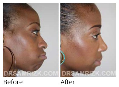 Female face, before and after Rhinoplasty treatment, side view, patient 31