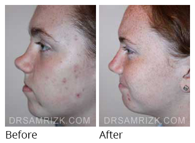 Female face, before and after Rhinoplasty treatment, side view, patient 32