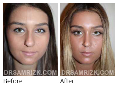 Female face, before and after Rhinoplasty treatment, front view, patient 33
