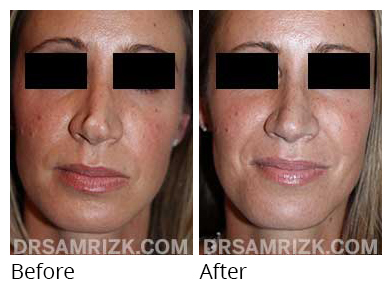 Female face, before and after Rhinoplasty treatment, front view, patient 34