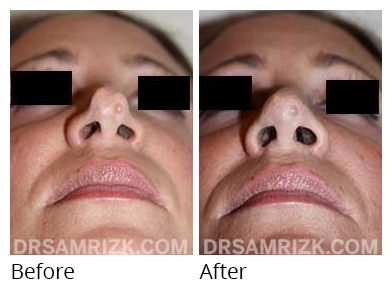 Female face, before and after Rhinoplasty treatment, below view, patient 34