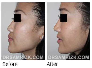 Female face, before and after Rhinoplasty treatment, side view, patient 35