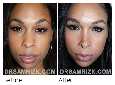 Female face, before and after Rhinoplasty treatment, front view, patient 36