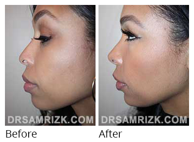Female face, before and after Rhinoplasty treatment, side view, patient 36