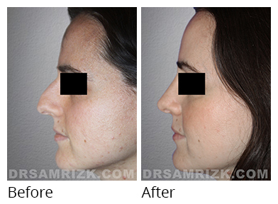 Female face, before and after Rhinoplasty treatment, side view, patient 37