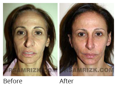 Female face, before and after Rhinoplasty treatment, front view, patient 38