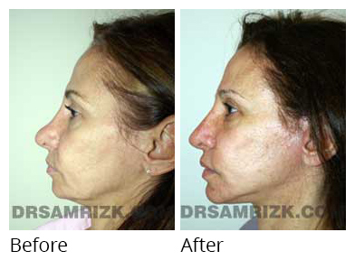 Female face, before and after Rhinoplasty treatment, side view, patient 38