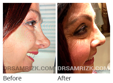 Female face, before and after Rhinoplasty treatment, side view, patient 39