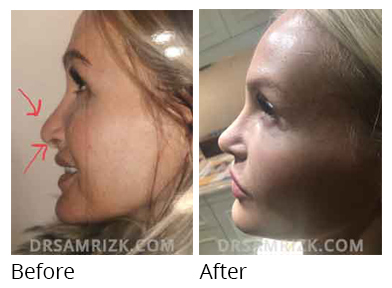 Female face, before and after Rhinoplasty treatment, side view, patient 40