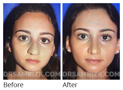 Female face, before and after Rhinoplasty treatment, front view, patient 41