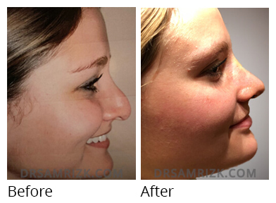 Female face, before and after Rhinoplasty treatment, side view, patient 42