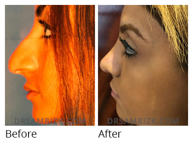 Female face, before and after Rhinoplasty treatment, side view, patient 43