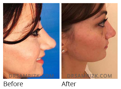 Female face, before and after Rhinoplasty treatment, side view, patient 44