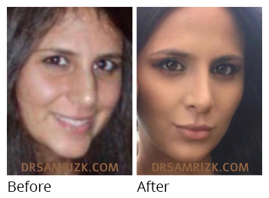 Female face, before and after Rhinoplasty treatment, front view, patient 45