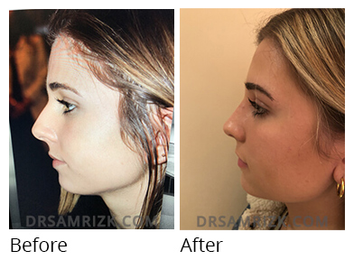 Female face, before and after Rhinoplasty treatment, side view, patient 46