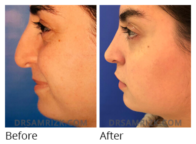 Female face, before and after Rhinoplasty treatment, side view, patient 47
