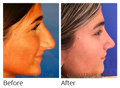 Female face, before and after Rhinoplasty treatment, side view, patient 48