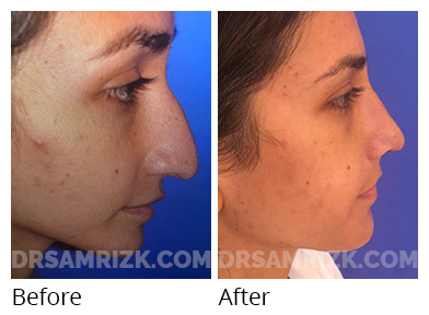 Female face, before and after Rhinoplasty treatment, side view, patient 49