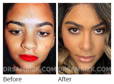 Female face, before and after Rhinoplasty treatment, front view - patient 50