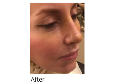 Female face, after Rhinoplasty treatment, oblique view, patient 51