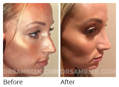 Female face, before and after Rhinoplasty treatment, oblique view, patient 52