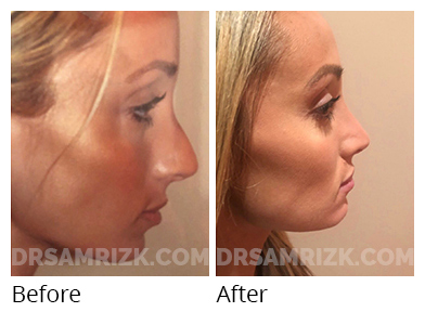 Female face, before and after Rhinoplasty treatment, side view, patient 52