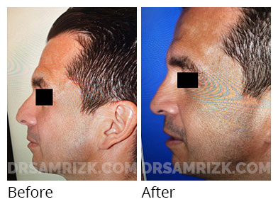 Male face, before and after Rhinoplasty treatment, side view, patient 1