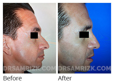Male face, before and after Rhinoplasty treatment, side view - patient 1