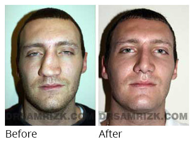 Male face, before and after Rhinoplasty treatment, front view, patient 2