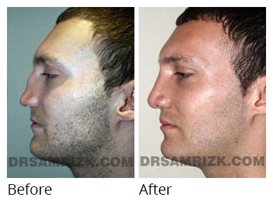 Male face, before and after Rhinoplasty treatment, side view - patient 2