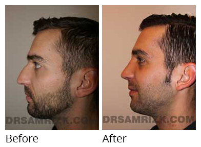 Male face, before and after Rhinoplasty treatment, side view, patient 3