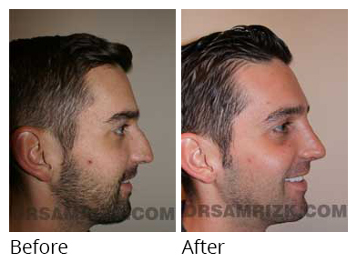 Male face, before and after Rhinoplasty treatment, side view - patient 3