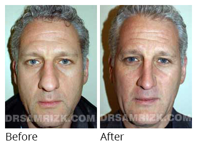 Male face, before and after Rhinoplasty treatment, front view, patient 4