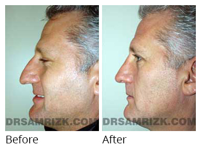 Male face, before and after Rhinoplasty treatment, side view, patient 4