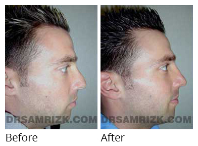 Male face, before and after Rhinoplasty treatment, side view, patient 5