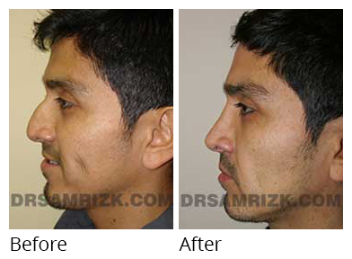 Male face, before and after Rhinoplasty treatment, side view, patient 6