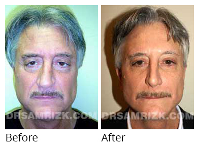 Male face, before and after Rhinoplasty treatment, front view, patient 7