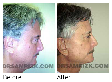 Male face, before and after Rhinoplasty treatment, side view, patient 7