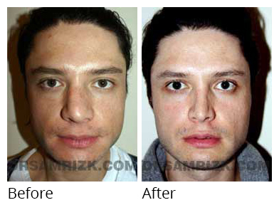 Male face, before and after Rhinoplasty treatment, front view, patient 8