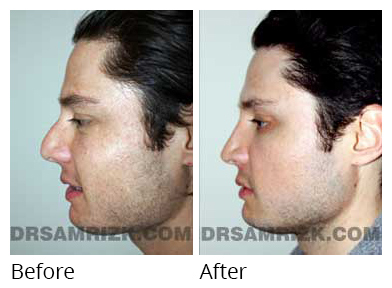 Male face, before and after Rhinoplasty treatment, side view, patient 8