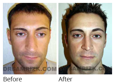 Male face, before and after Rhinoplasty treatment, front view, patient 9