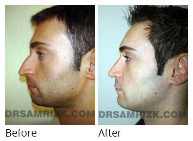 Male face, before and after Rhinoplasty treatment, side view, patient 9