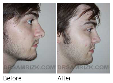 Male face, before and after Rhinoplasty treatment, side view, patient 10