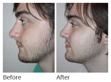 Male face, before and after Rhinoplasty treatment, side view - patient 10