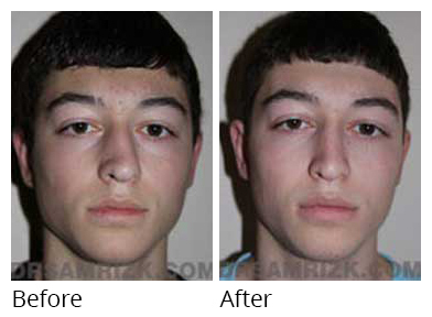Male face, before and after Rhinoplasty treatment, front view, patient 11